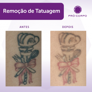 Remoção de Tatuagem: Fotos de Antes e Depois